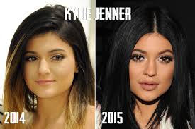 We uncover all cosmetic surgeries that kylie jenner has undergone alongwith faqs on kylie jenner plastic surgery. Kylie Jenner Lips Before After Dr Siew Dr Siew Com
