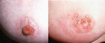 Paget S Disease