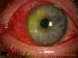 There are two types of herpes simplex virus (hsv) which are capable of causing an acute viral infection characterised by clusters of vesicles. Corneal Marginal Ulcer