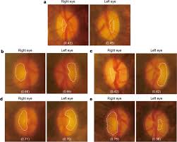 Glaucoma is a progressive vision condition that can lead to permanent blindness. Normal Tension Glaucoma Like Degeneration Of The Visual System In Aged Marmosets Scientific Reports
