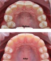 Perfect Arched Teeth By Dr Nathan Le Dentist Penrith Sydney Braces Teeth Care Teeth Dentist