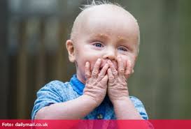 Ştiri externe-Fața unui copil este atât de uscată încât nu poate nici măcar  clipi. Părinții trebuie să-l dea mereu cu cremă