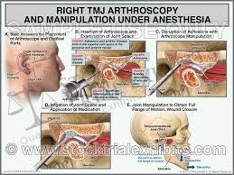 Tmj Right Arthroscopy With Manipulation Male Tmj Temporomandibular Joint Manipulation