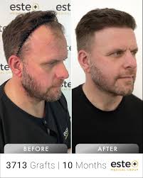 10 months later, Jeffrey Chambers' transformation is simply incredible! 💯  With 3713 grafts, his hair transplant journey has delivered amazing  progress. ✨ Contact us now: 📲WhatsApp: +90 546 903 37 84 👉Website: