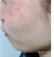 杉山愛 これ使ってます 紫外線浴び続けた人のシミ対策は説得力抜群 ガールズコスメplus シミ 美容クリニック シミ 化粧品