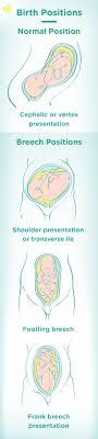 Learn how to turn a breech baby with techniques that work for most pregnancies. Breech Baby Meaning Causes And Birth Pampers