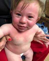 Mum Claims Son Suffered Allergic Reaction To Child Friendly Paint At Nursery Because It Contains Milk And Egg
