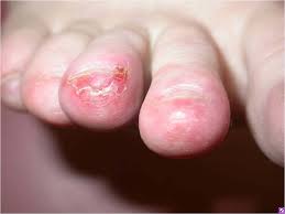 Image result for Chilblains