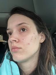 Hormone kit helps with facial issues