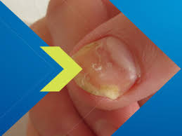 Image result for mykoza nehtů