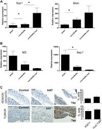 We did not find results for: How Asbestos Drives The Tissue Towards Tumors Yap Activation Macrophage And Mesothelial Precursor Recruitment Rna Editing And Somatic Mutations Oncogene