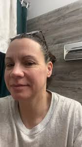 Using Original Skin Repair for Wind Burn in Ashland, WI