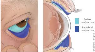 Image result for Conjunctivitis Resources