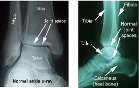Image result for Ankle XRay