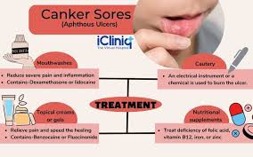 Image result for Canker sores symptoms roof of the mouth