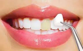 See what braces, crowns, veneers, teeth whitening, bridges, im. 5 Most Affordable Cosmetic Dentistry Procedures Dr Fitzgerald