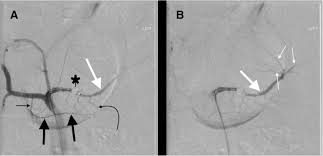 The intentional blockage of an artery with an object (as a balloon inserted by a catheter) to control or prevent hemorrhaging. Review Of Proximal Splenic Artery Embolization In Blunt Abdominal Trauma Cvir Endovascular Full Text