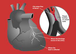 Nationwide evaluations of the epidemiology of acute coronary syndrome (acs) or cerebrovascular syndrome (cvs) are scarce. Acute Coronary Syndrome Wikipedia