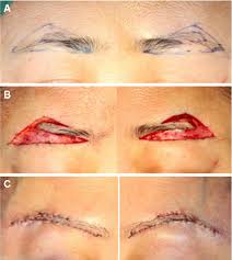 Under eye skin tightening using multiple methods including skinbooster, fractional laser and dermal fillers and a brow lift. A Novel Supra Brow Combined With Infra Brow Lift Approach For Asian Women Semantic Scholar