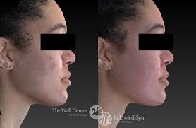 Fraxel Laser Skin Resurfacing Before and After Pictures Case 906