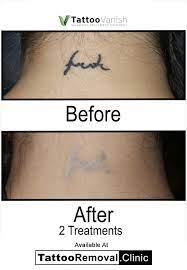 Find useful information, the address and the phone number of the local business you are looking for. Tattoo Removal Clinic Toronto The Premier Laser Non Laser Tattoo Removal Clinic