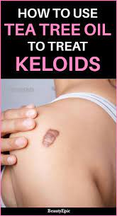 How To Use Tea Tree Oil For Keloids Tea Tree Oil Natural Cough Remedies Cold Sores Remedies