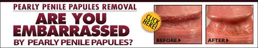 Maybe you would like to learn more about one of these? How To Get Rid Of Pearly Penile Papules Smartersex Org