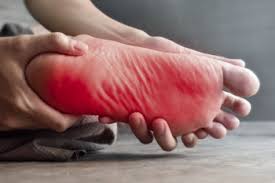 Image result for Peripheral Neuropathy