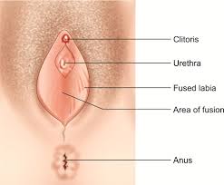 Image result for Labial Fusion