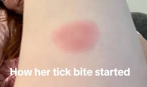 Image result for infected tick bite