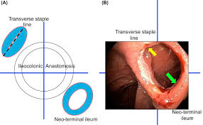 For example, an arterial anastomosis is used in vascular bypass and a colonic anastomosis is used to. Intestine Resection An Overview Sciencedirect Topics