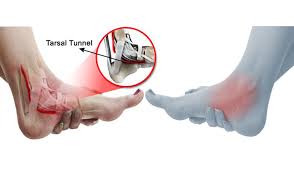 Tarsal Tunnel Syndrome Physical Therapy Clinic Aventura Sos Physio