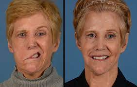 Dec 04, 2017 · bell's palsy causes weakness or paralysis of the muscles on one side of the face. How Susan Got Her Smile Back A Journey Overcoming Facial Paralysis Plastic Surgery Ut Southwestern Medical Center