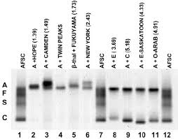 Alkaline Hemoglobin Electrophoresis Performed On Helena