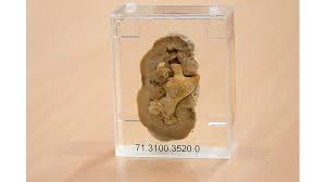 You will also discuss ways to prevent getting more kidney stones in the future. Staghorn Kidney Stone Imperial College Pathology Museum Imperial College Pathology Imperial College London