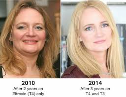 Before And After T3 Healthy Thyroid Hypothyroidism Diet Thyroid Health
