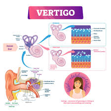 Image result for Vertigo Management