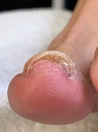 Image result for Onychotillomania feet