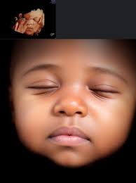 Check Out This 4D Ultrasound! 🥰🔥 I am currently 35 weeks pregnant with a  baby girl!  [https://www.tubal-reversal.net/patient-satisfaction/reversing-burned-tubes-35-weeks-pregnant-with-a-baby-girl/](https://www.tubal-reversal.net/patient-satisfaction  ...