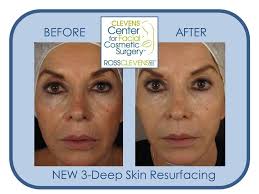 Skin Resurfacing Skin Resurfacing Laser Skin Resurfacing Laser Skin