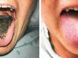 Image result for black hairy tongue symptoms