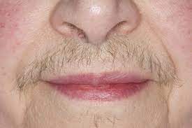Your biggest covid hair catastrophes that just won't stop! Facial Hirsutism Oncology Nurse Advisor