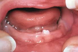 When the bump is caused by oral cancer, you are most likely to according to nhs, corticosteroid lozenges can be very effective in treating oral bumps. Managing Dental Emergencies In Community Pharmacy Soft Tissue Conditions The Pharmaceutical Journal