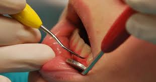 Harga veneer gigi tidaklah mahal mana. Apa Itu Scaling Gigi Atau Cuci Gigi The Diagnosa