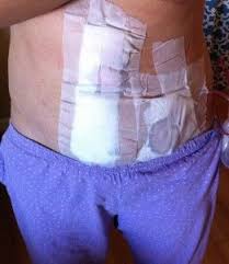Diastasis Recti Surgery Photos It S A Love Love Thing Diastasis Recti Diastasis Recti Repair Diastasis Recti Exercises