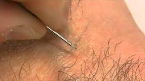 Check the ingrown hair bump daily for the hair loop 2. How To Remove An Ingrown Hair Youtube