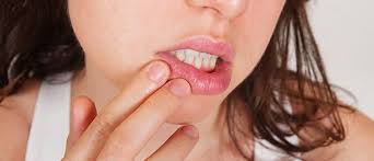 Elles sont gênantes, mais elles guérissent en général en quelques jours. Aphtes Dentalcare