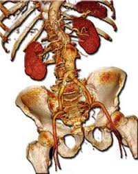 Chirurgie Mit Schwerpunkt Gefasschirurgie Aortenaneurysma