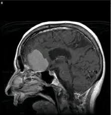Medical School Brain Tumor Ct Scan Medical Knowledge