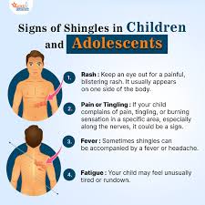 Image result for shingles in children